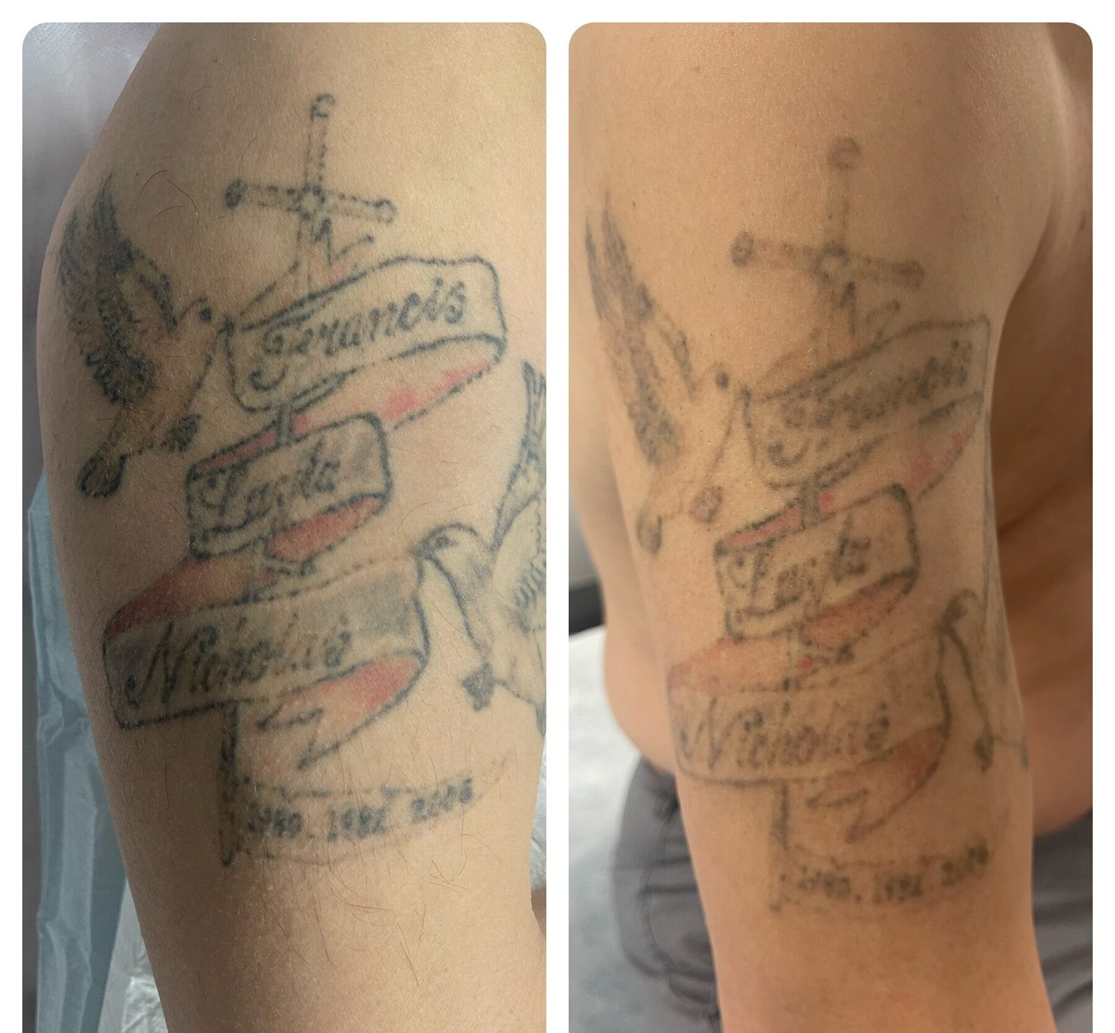 Laser Tattoo Removal in Kellyville