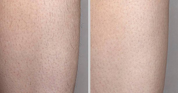Skin before and after hair removal. Collage with and without hair, smooth skin. Self-care and cosmetic services concept. macro close up