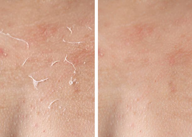 Dry skin before and after moisturizing, marco view. Collage for comparison