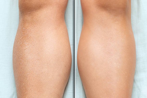Before and after skin moisturization in detail, with dried and cracked skin against a flawless smooth complexion on woman legs.