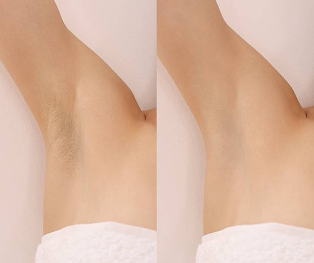 Epilation and depilation. Collage with photos of woman showing armpit after different procedures on light background, closeup